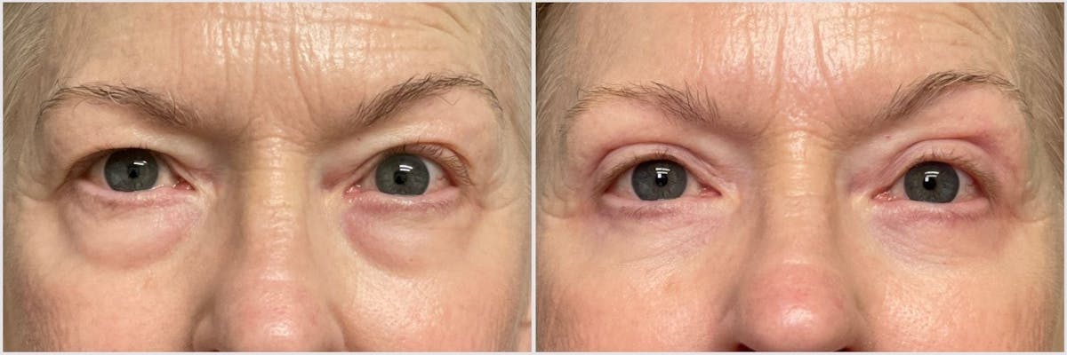 Upper & Lower Blepharoplasty Before & After Gallery - Patient 683919 - Image 1