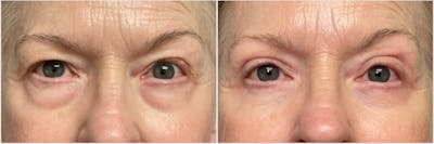 Upper & Lower Blepharoplasty Before & After Gallery - Patient 683919 - Image 1