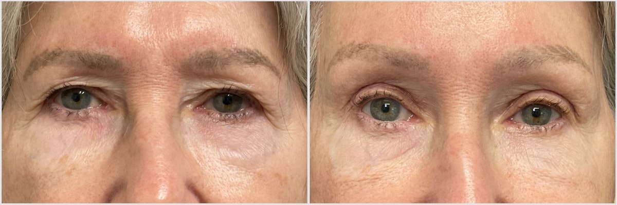 Upper Blepharoplasty Before & After Gallery - Patient 113360 - Image 1
