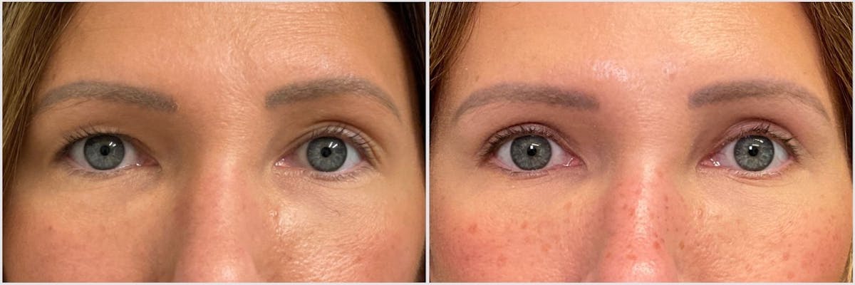 Upper Blepharoplasty Before & After Gallery - Patient 494742 - Image 1