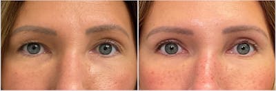 Upper Blepharoplasty Before & After Gallery - Patient 494742 - Image 1
