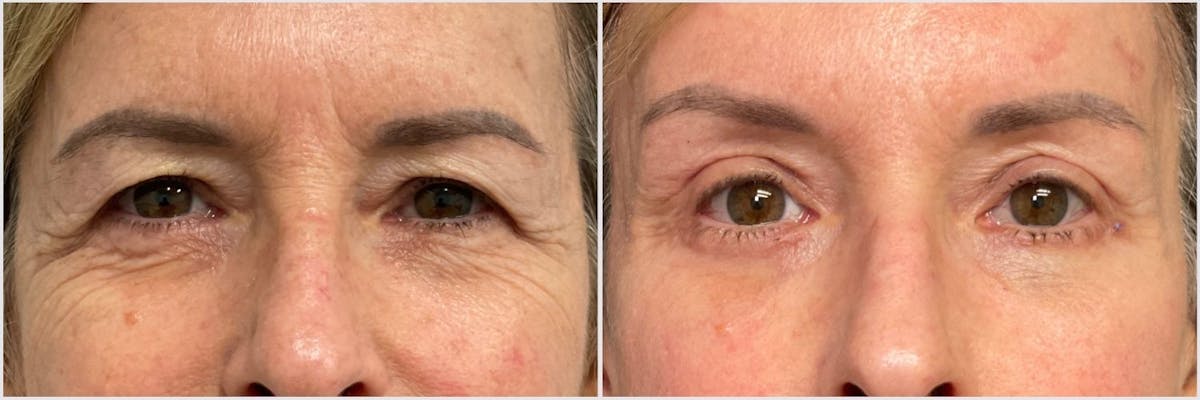 Brow Lift Before & After Gallery - Patient 146425 - Image 1