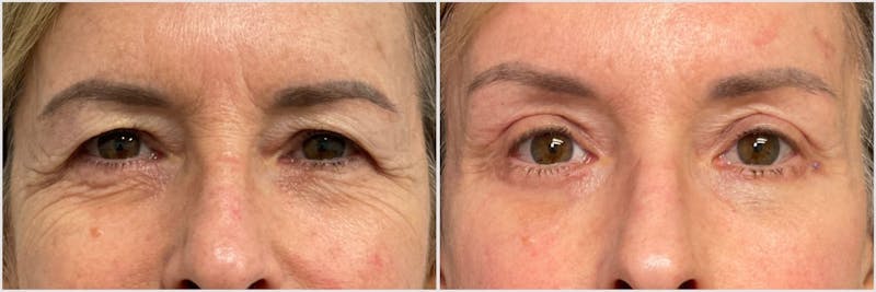 TCA Peel Before & After Gallery - Patient 952131 - Image 1