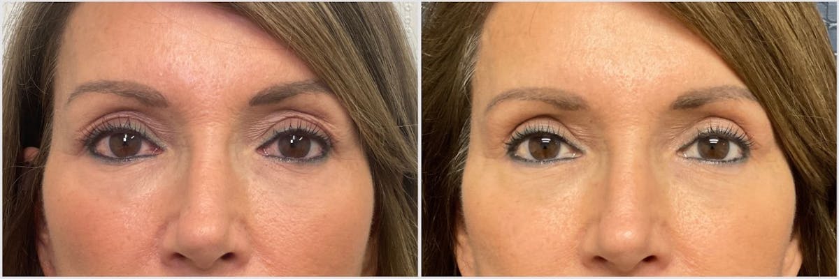 Upper Blepharoplasty Before & After Gallery - Patient 341046 - Image 1