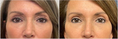 Upper Blepharoplasty Before & After Gallery - Patient 341046 - Image 1