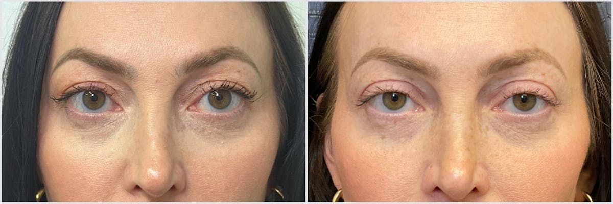 Upper Blepharoplasty Before & After Gallery - Patient 134706 - Image 1
