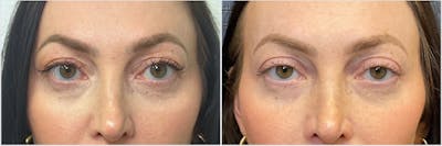 Upper Blepharoplasty Before & After Gallery - Patient 134706 - Image 1