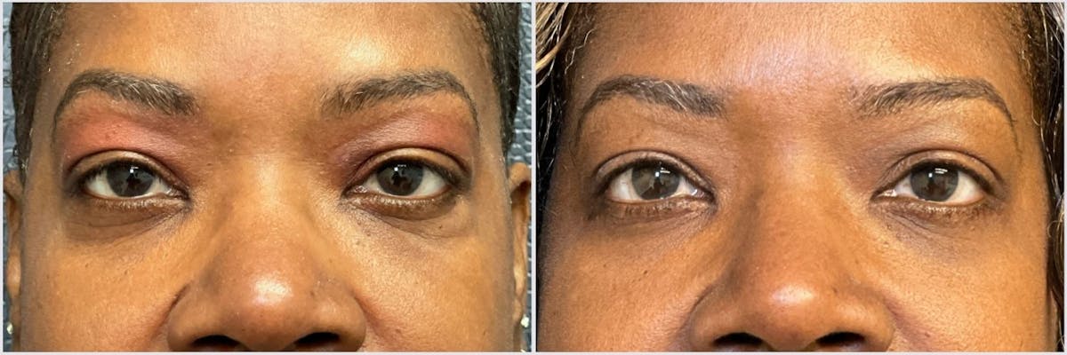 Lower Blepharoplasty Before & After Gallery - Patient 732112 - Image 1