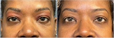 Lower Blepharoplasty Before & After Gallery - Patient 732112 - Image 1