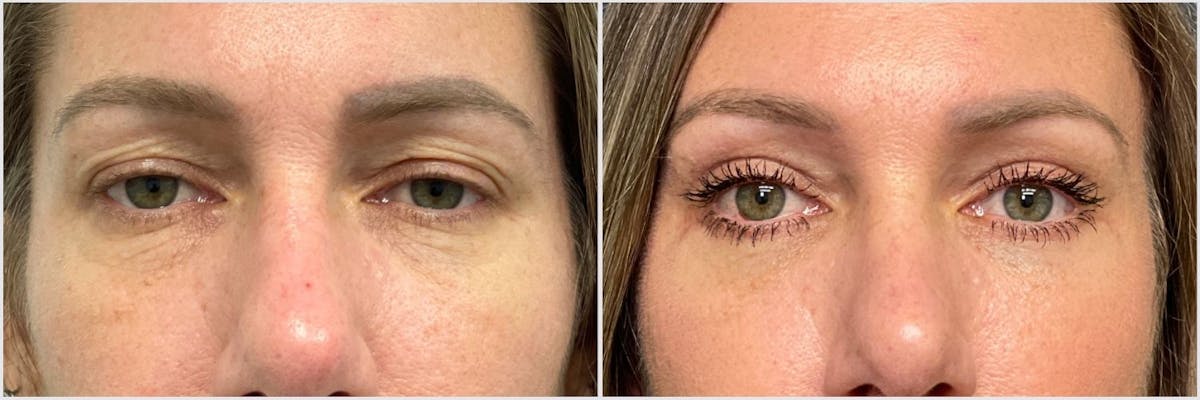 Brow Lift Before & After Gallery - Patient 333666 - Image 1