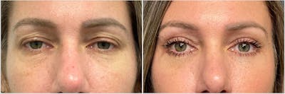 Upper & Lower Blepharoplasty Before & After Gallery - Patient 380915 - Image 1