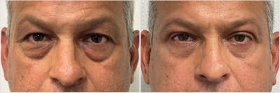 Upper & Lower Blepharoplasty Before & After Gallery - Patient 404302 - Image 1