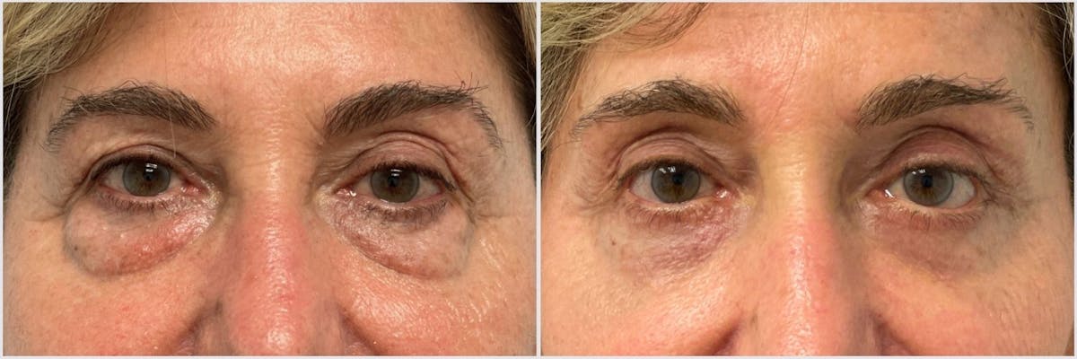 Lower Blepharoplasty Before & After Gallery - Patient 282250 - Image 1