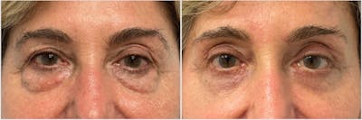 Lower Blepharoplasty Before & After Gallery - Patient 282250 - Image 1