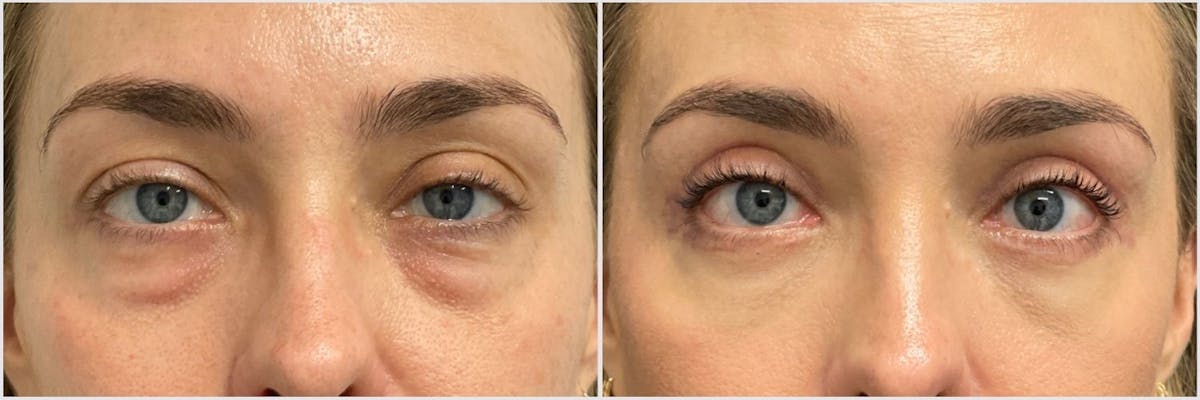 Upper Blepharoplasty Before & After Gallery - Patient 467732 - Image 1