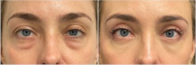 Ptosis Repair Before & After Gallery - Patient 317971 - Image 1