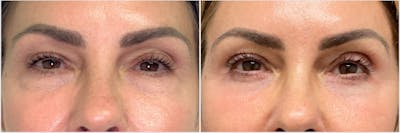 TCA Peel Before & After Gallery - Patient 141926 - Image 1