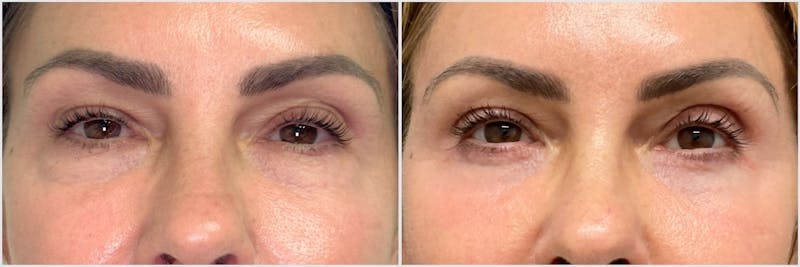 TCA Peel Before & After Gallery - Patient 141926 - Image 1