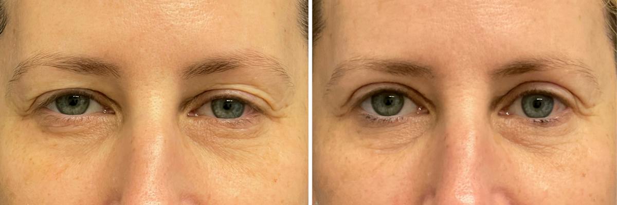 Upper Blepharoplasty Before & After Gallery - Patient 210864 - Image 1