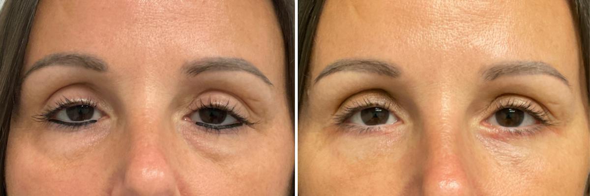 Lower Blepharoplasty Before & After Gallery - Patient 155420 - Image 1