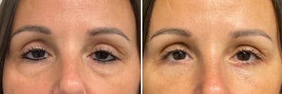 Lower Blepharoplasty Before & After Gallery - Patient 155420 - Image 1