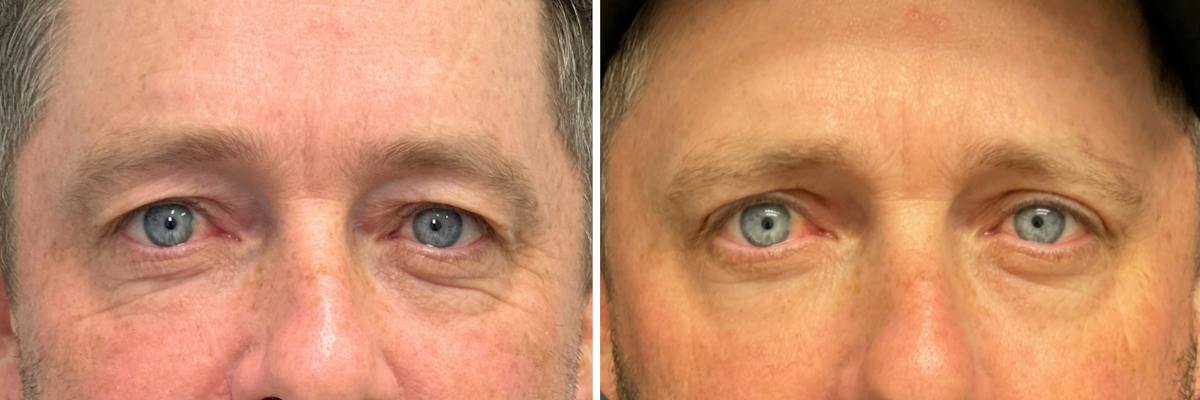 Upper Blepharoplasty Before & After Gallery - Patient 324170 - Image 1