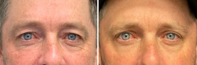 Upper Blepharoplasty Before & After Gallery - Patient 324170 - Image 1