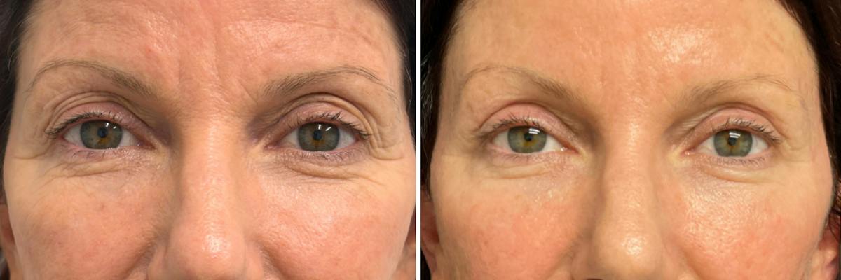Upper & Lower Blepharoplasty Before & After Gallery - Patient 211130 - Image 1