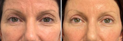 Upper Blepharoplasty Before & After Gallery - Patient 218364 - Image 1
