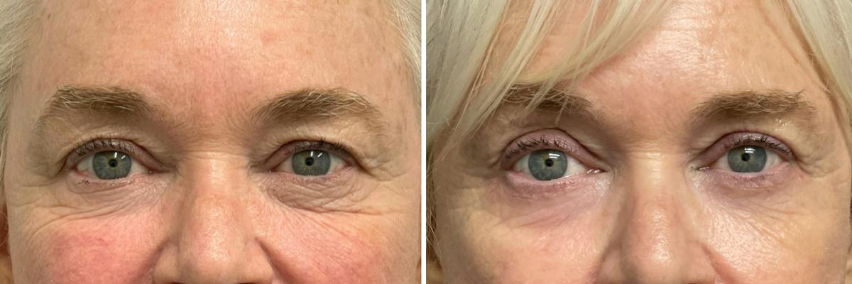 Upper & Lower Blepharoplasty Before & After Gallery - Patient 889597 - Image 1