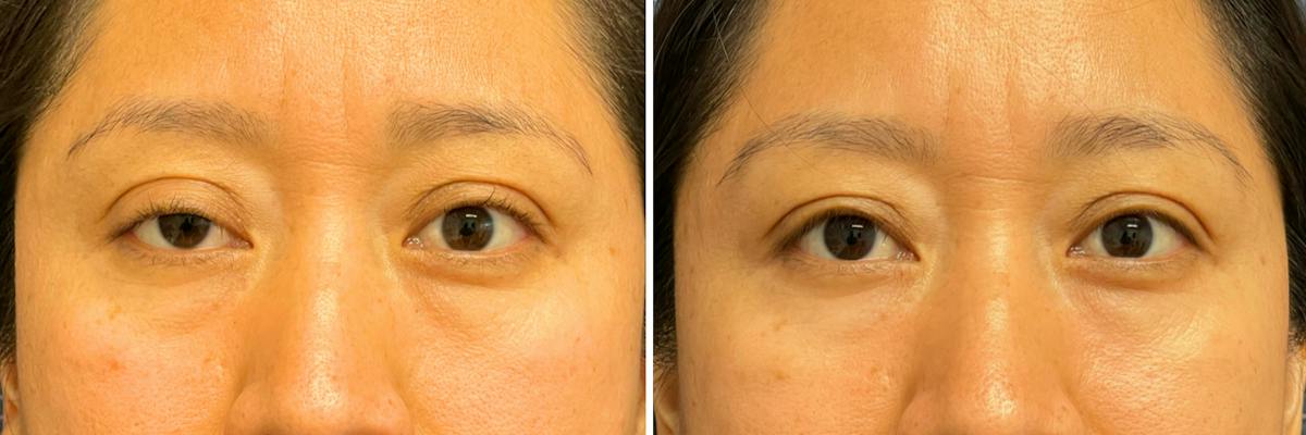 Upper Blepharoplasty Before & After Gallery - Patient 223935 - Image 1