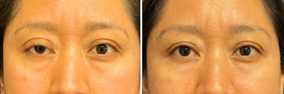 Upper Blepharoplasty Before & After Gallery - Patient 223935 - Image 1
