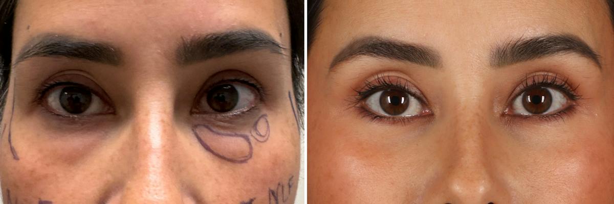Upper & Lower Blepharoplasty Before & After Gallery - Patient 237363 - Image 1