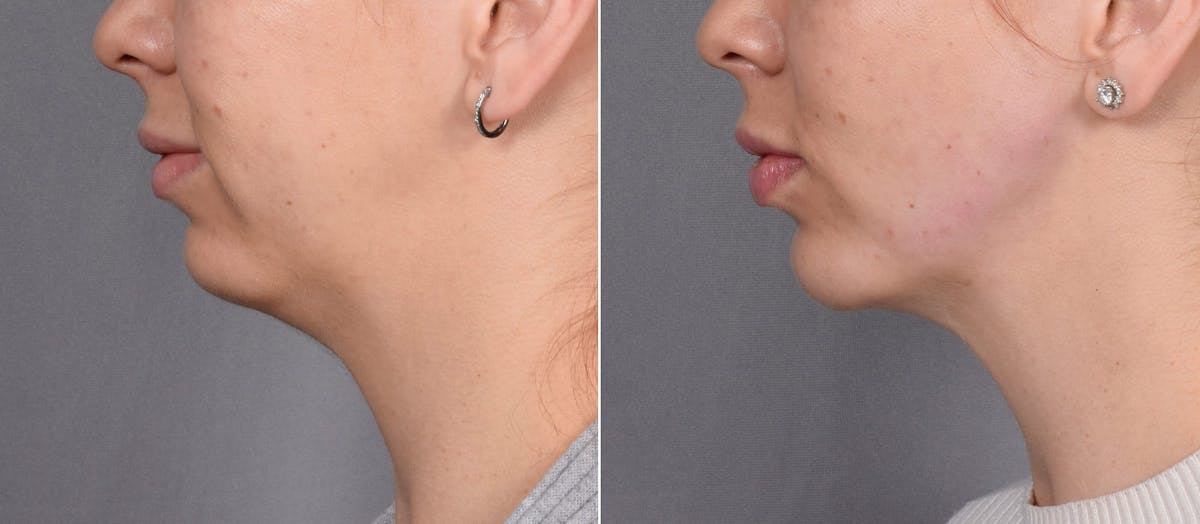 Chin Implant Before & After Gallery - Patient 381319 - Image 5