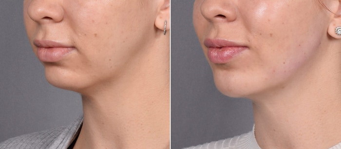 Chin Implant Before & After Gallery - Patient 381319 - Image 1
