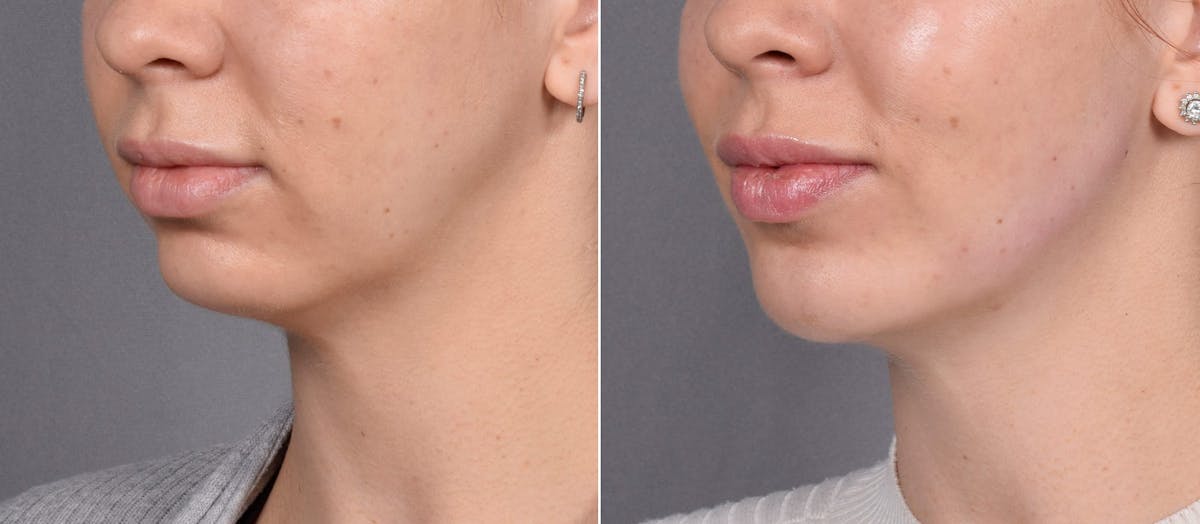 Chin Implant Before & After Gallery - Patient 381319 - Image 1