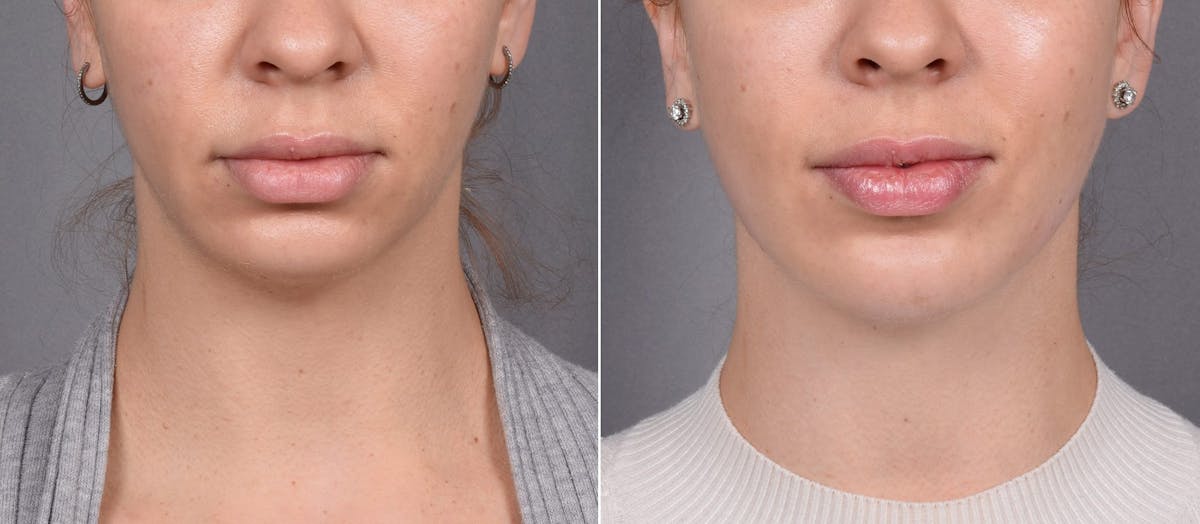 Chin Implant Before & After Gallery - Patient 381319 - Image 4