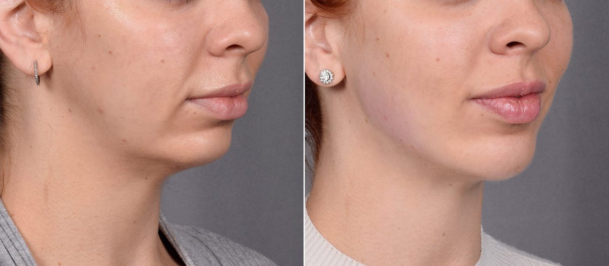 Chin Implant Before & After Gallery - Patient 381319 - Image 2