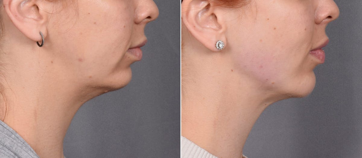Chin Implant Before & After Gallery - Patient 381319 - Image 3
