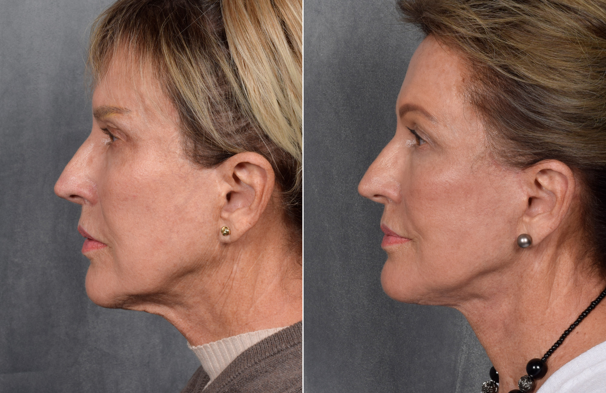 Facelift Before & After Gallery - Patient 160149 - Image 7