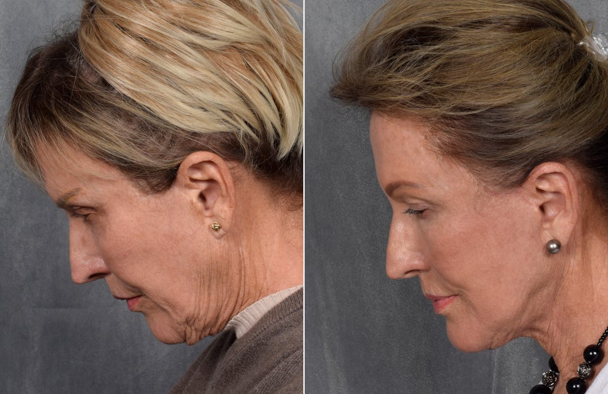 Facelift Before & After Gallery - Patient 160149 - Image 3