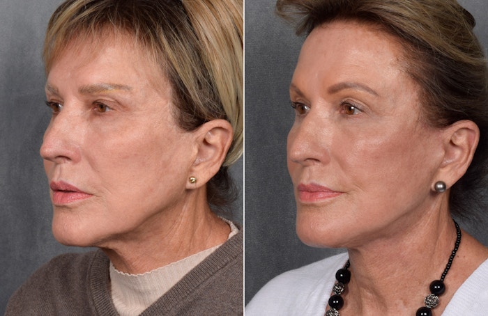 Facelift Before & After Gallery - Patient 160149 - Image 1