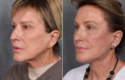 Facelift Before & After Gallery - Patient 160149 - Image 1