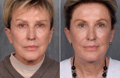 Facelift Before & After Gallery - Patient 160149 - Image 1
