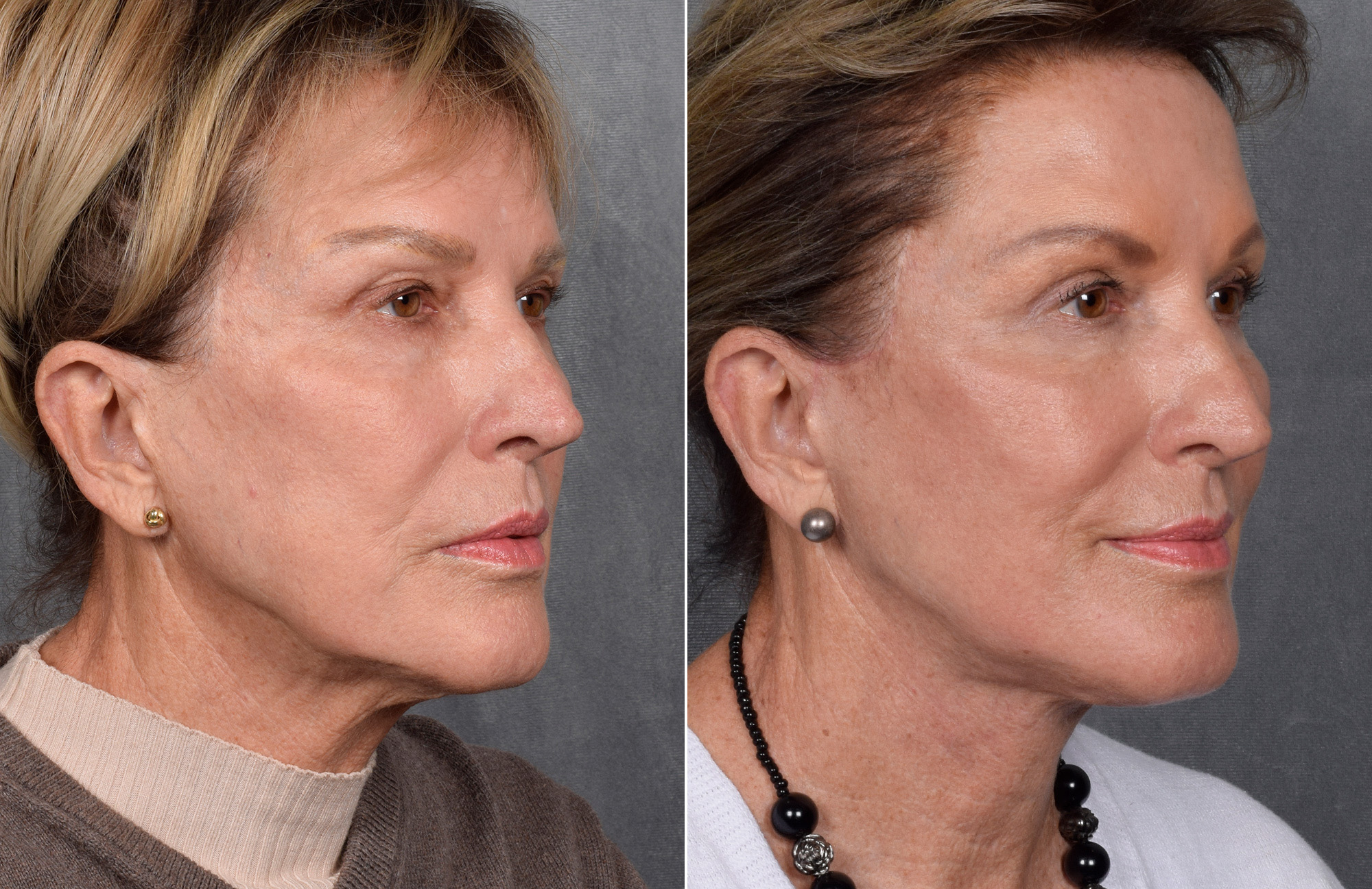 Facelift Before & After Gallery - Patient 160149 - Image 1