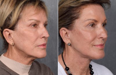 Facelift Before & After Gallery - Patient 160149 - Image 1