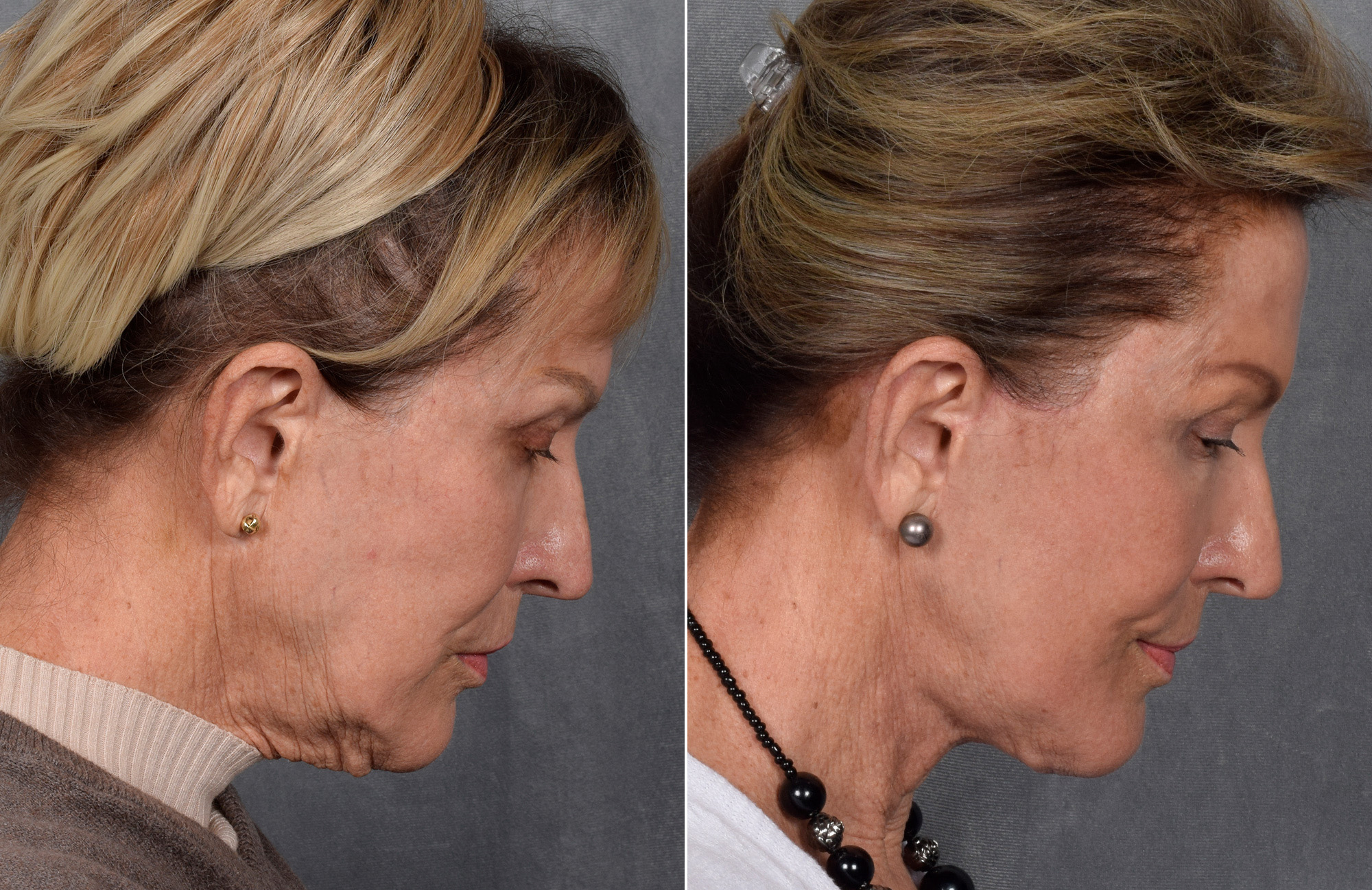Facelift Before & After Gallery - Patient 160149 - Image 4