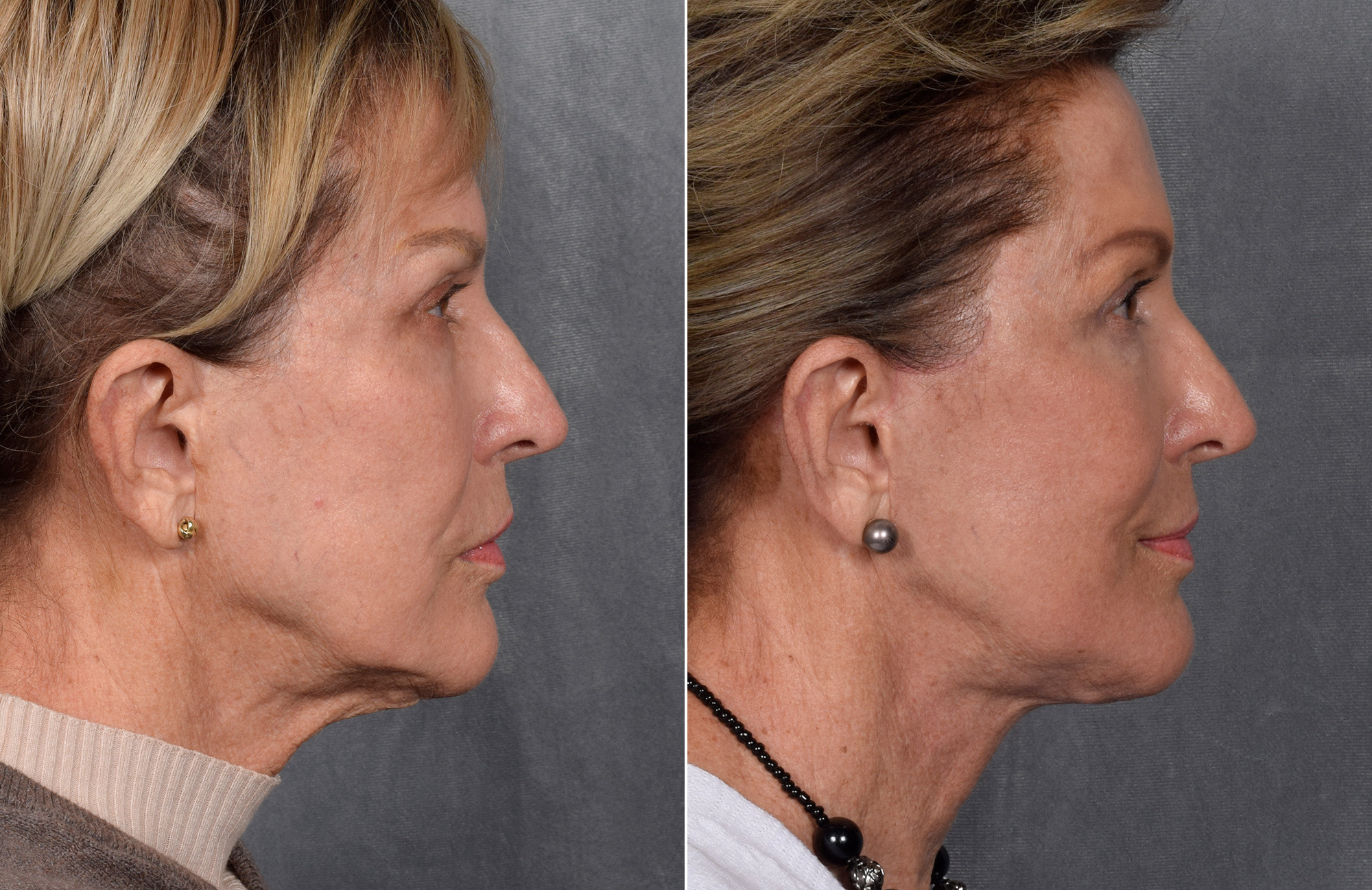 Facelift Before & After Gallery - Patient 160149 - Image 2