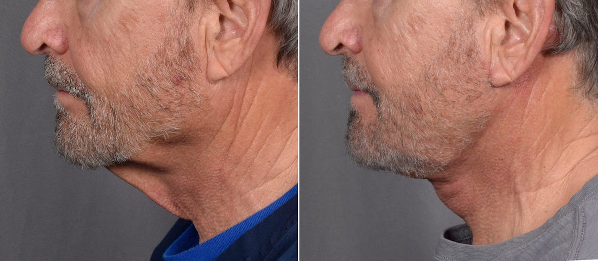 Neck Lift Before & After Gallery - Patient 865548 - Image 5