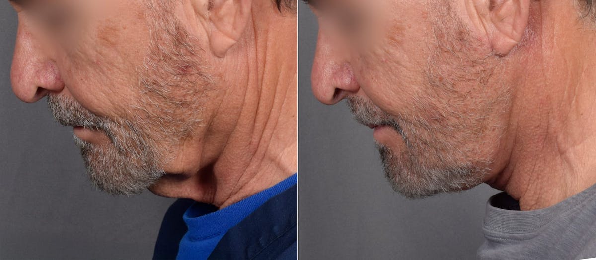 Neck Lift Before & After Gallery - Patient 865548 - Image 4